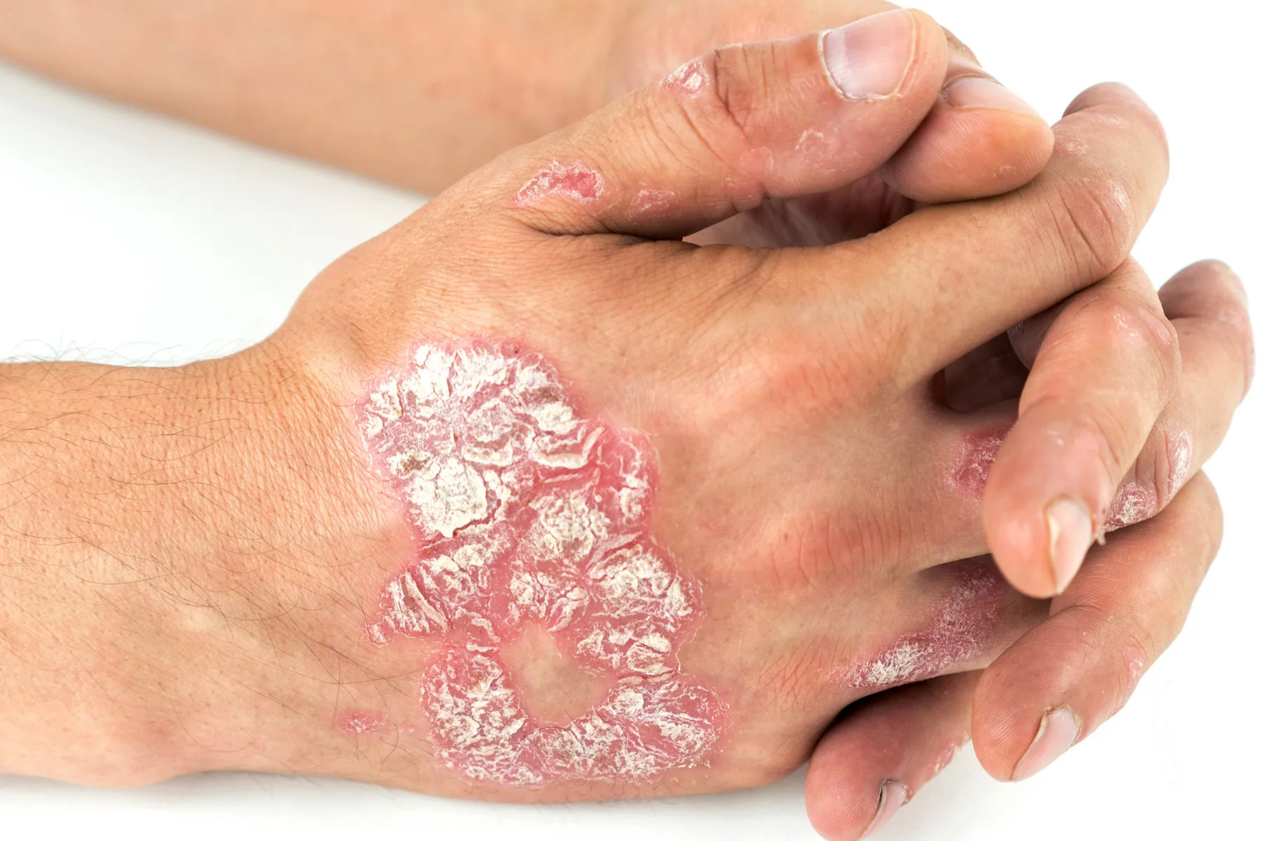 Neem (Azadirachta indica) in immunomodulation and inflammatory plaque psoriasis